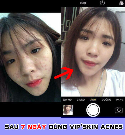 kết quả sau khi dùng kem trị mụn vip'skin acnes